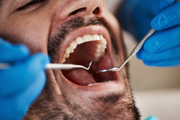 Best Emergency Wisdom Teeth Removal in Alexandria, MN